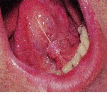 Infection au VPH dans certaines maladies bucco-dentaires