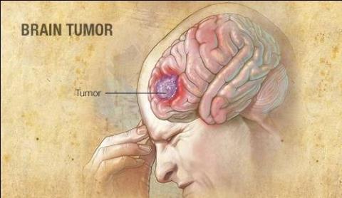 Brain cancer: Symptoms, causes and treatment