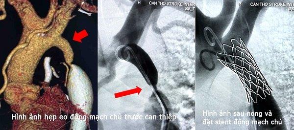 Coarctation de l'aorte : une cardiopathie congénitale passe facilement inaperçue