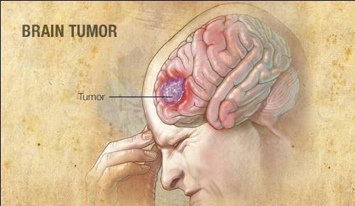 Kanser otak: Gejala, punca dan rawatan
