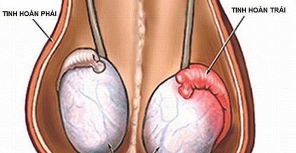 Puistjes op de testikels zijn een teken van welke ziekte?