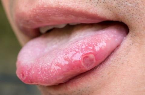 How to recognize tongue cancer: Warnings from experts