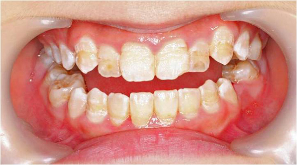 Enamel: The strongest structure in the body!