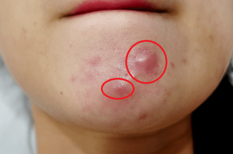 Squeeze acne properly: safe and effective