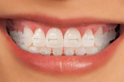 Porcelain braces: Benefits, notes and costs