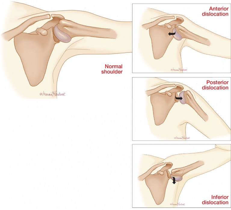 Conventional medicine: Dislocation of the shoulder