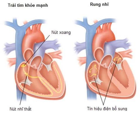 ภาวะหัวใจห้องบน: สาเหตุและอาการ