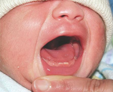 Things to note about abnormalities in teething and tooth development in children