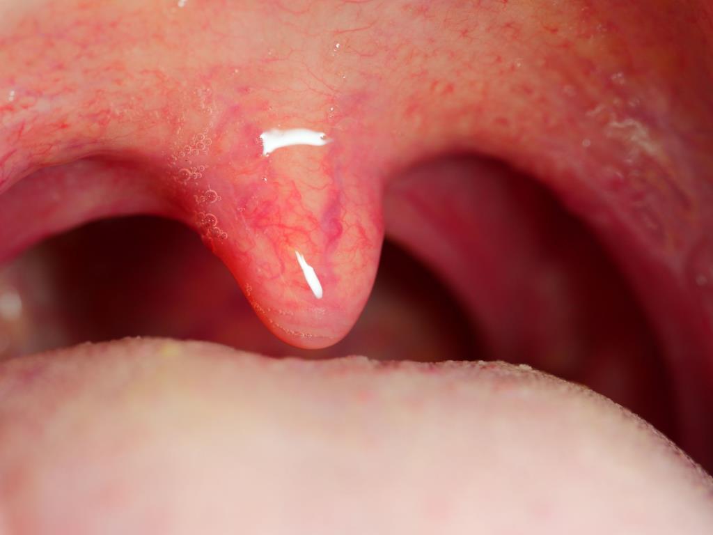 Things to know about swollen tongue