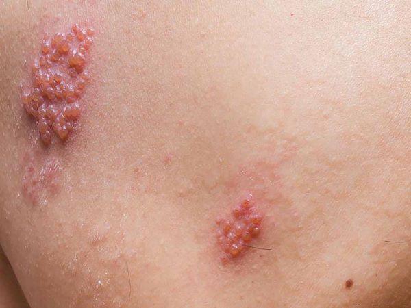 帯状疱疹：原因、症状および診断