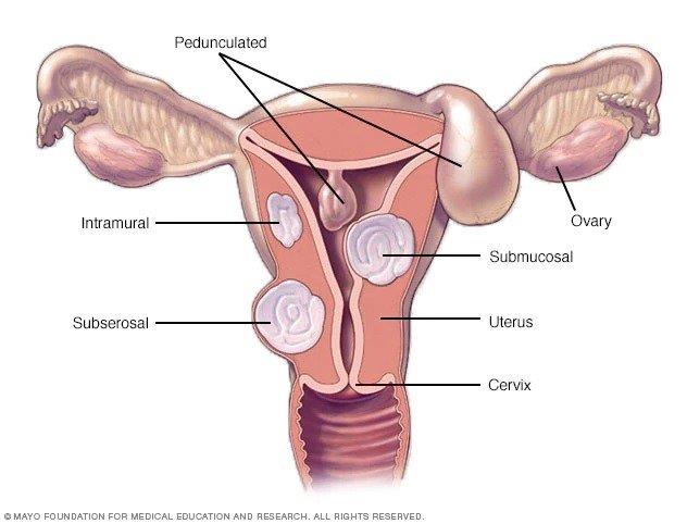 자궁 근종은 언제 위험합니까?