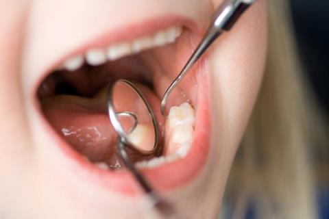 Dental fillings and things to know