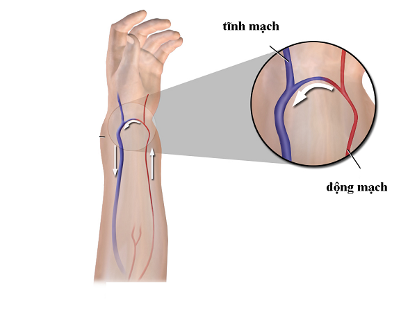 Fistule artério-veineuse : Comprendre pour bien se prendre en main !