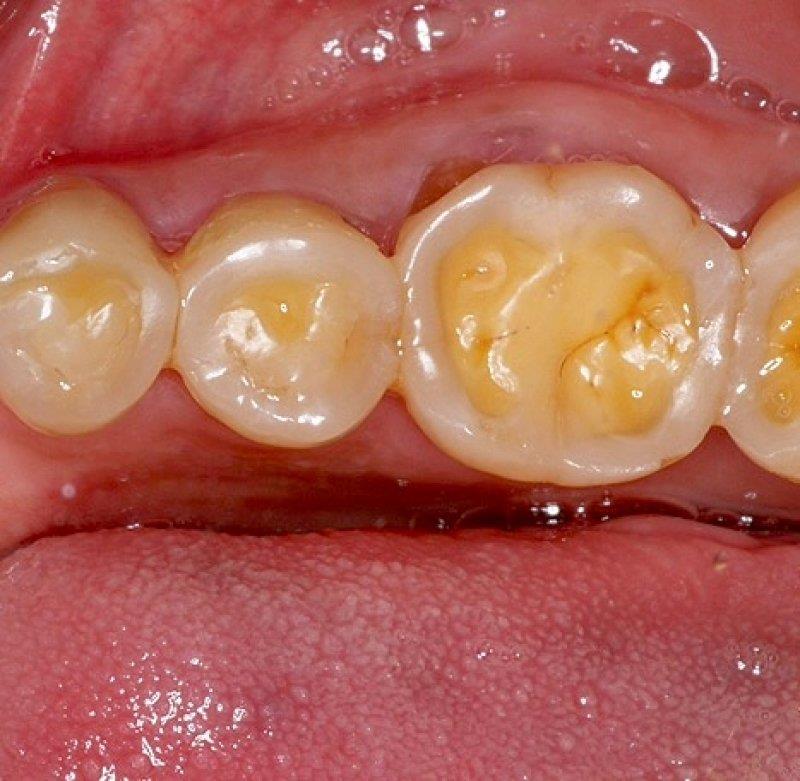 牙齒磨損：現代生活的困境