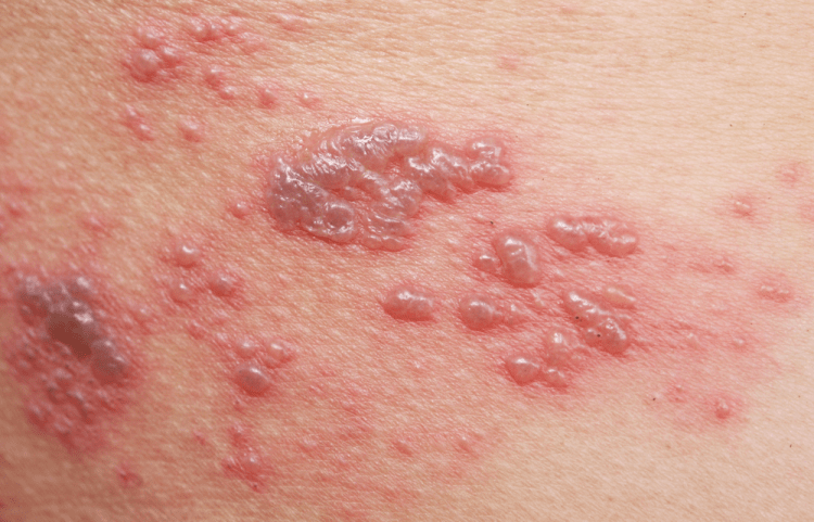 Symptoms and types of shingles you may experience • SignsSymptomsList.com