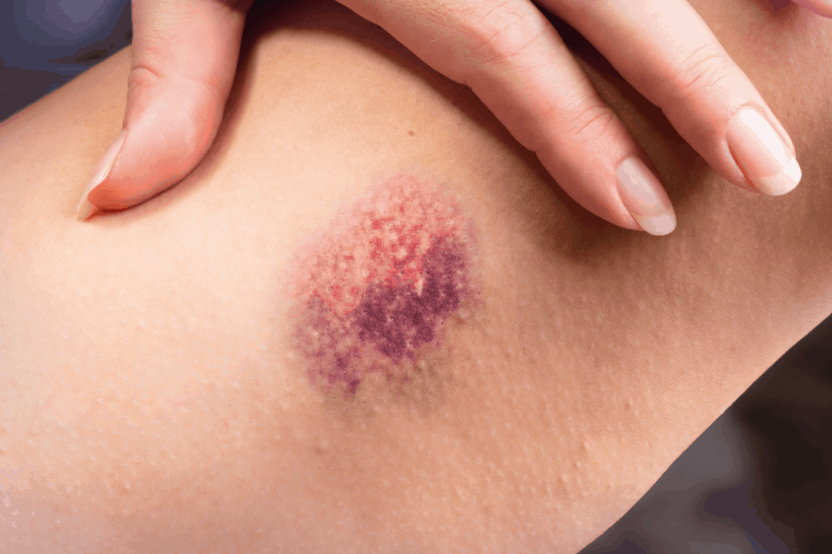 免疫性血小板減少性紫癜的8個症狀你已經知道了嗎？ • SignsSymptomsList.com